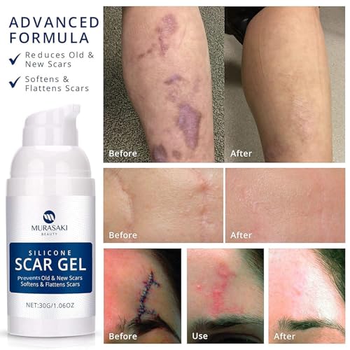 gel para cicatrices de quemaduras