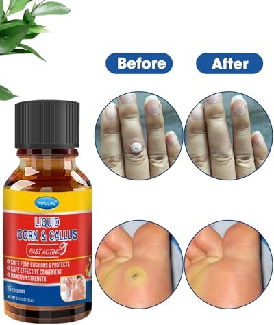 MYMULIKE Removedor de Maíz Líquido, Acción Rápida y Segura para Dedos, Extra Fuerte para Niños y Adultos, 15ml con 15 Almohadillas y 10 Aplicadores - imagen 4