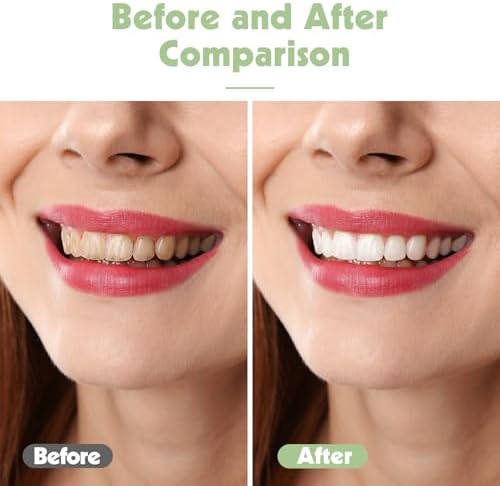 Juego de Cepillos de Dientes Lanjue de 6 Piezas, Cepillos Manuales Suaves para Adultos con Estuche de Viaje, Limpieza Profunda para Dientes Sensibles - imagen 5