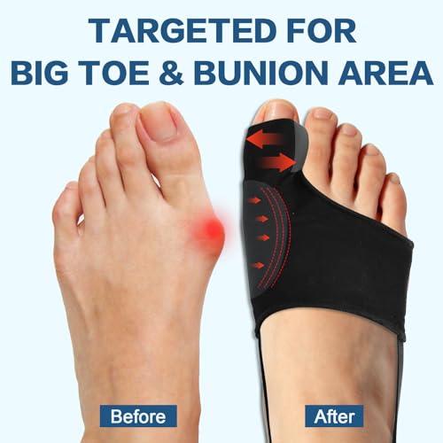 TEAWOO Corrector de Juanetes 2 Piezas para Hombres y Mujeres, Enderezador de Dedo Grande con Almohadillas y Férula, Alivio del Dolor de Hallux - imagen 2