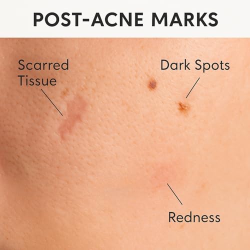 PARCHES PUREEASE para Cicatrices de Acné y Manchas Oscuras – Dots de Silicona No Adhesivos, Suaves para Piel Sensible – Ultra Delgados y - imagen 4