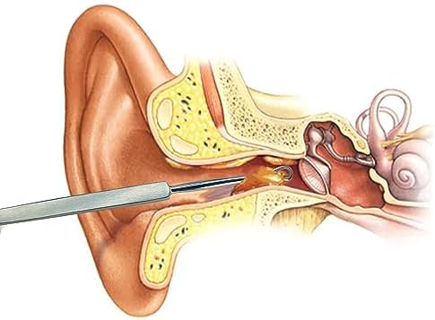 Herramienta para Remoción de Cera de Oído MJW – Cureta de Acero Inoxidable Profesional, Segura, Eficiente, Reutilizable y Ecológica para Todas las - imagen 7