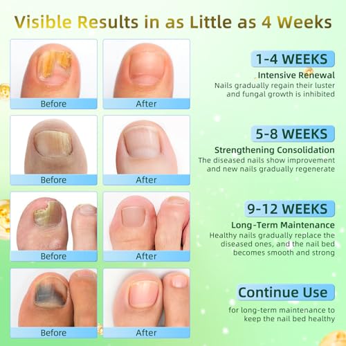 Lápiz Tratamiento para Hongos en Uñas Extra Fuerte – Repara Uñas Amarillas, Descoloridas, Gruesas y Encarnadas – Solución para Uñas de Pies y Manos – - imagen 3