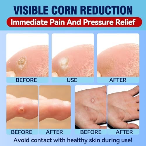 Bellemora Eliminadores de Callos para Dedos y Pies, Paquete de 24 Almohadillas con Adhesivo Impermeable, Alivio Suave del Dolor, Bandaid para Manos y - imagen 3