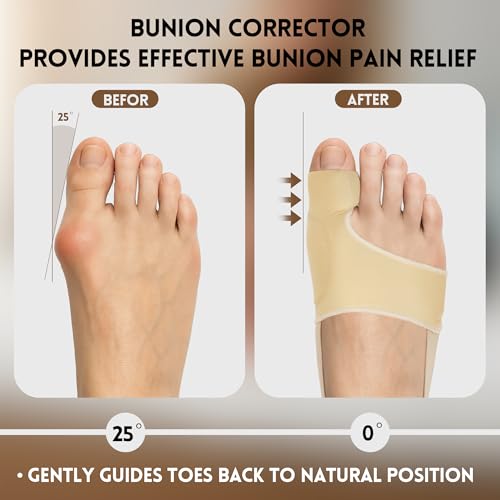 CHJOD 2 PZS Corrector de Juanetes para Mujeres y Hombres - Enderezador de Dedo Gordo con Splint y Almohadillas, Soporte Cómodo para Alivio de Dolor - imagen 4