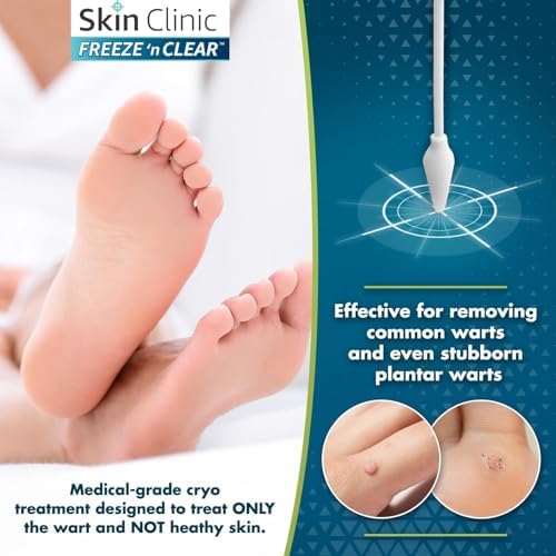 Skin Clinic Freeze 'n Clear Removedor Avanzado de Verrugas - Kit de Crioterapia Hecho en EE.UU. con 12 Aplicadores de Precisión - Tratamiento - imagen 5