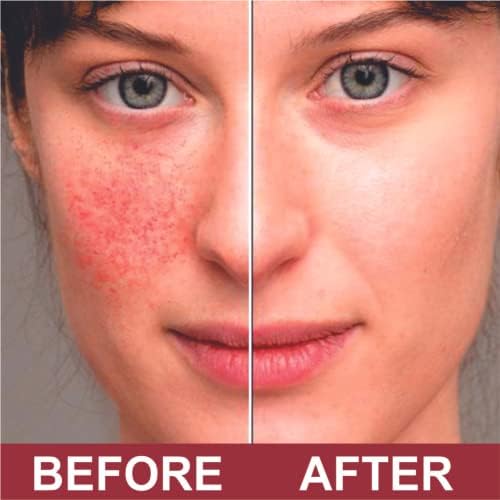 Crema Antipicazón QUATRIDERM NF Extra Fuerte 1% Hidrocortisona con Aloe Vera, Sin Parabenos, 2 oz para Erupciones y Condiciones de Piel - imagen 5