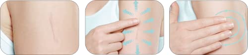 Mederma Cuidado de la Piel (Ayuda con Cicatrices - Cirugía, Lesiones, Quemaduras, Acné, Estrías) - imagen 3