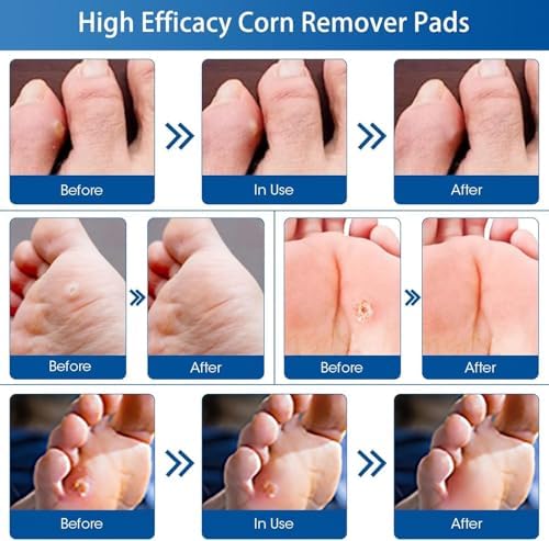 Paquete de 48 Almohadillas para Remover Callos en Pies y Dedos, Eliminador de Callos Extra Fuerte - imagen 7