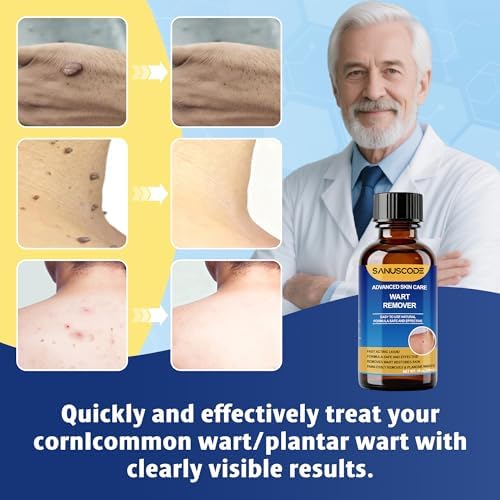 Sanuscode Removedor de Verrugas Líquido con 17% de Ácido Salicílico, Kit de Eliminación Rápida para Verrugas Plantares y Comunes, 30 ml - imagen 5