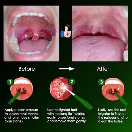 Herramienta Mejorada Airgoesin para Remover Piedras de Amígdalas con 2 Luces + Jeringa de Irrigación para Enjuague Oral y Aliento Fresco - imagen 8
