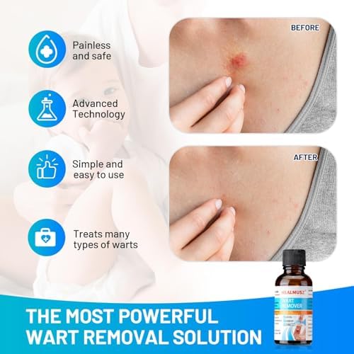 HEALMUSZ Líquido Removedor de Verrugas Plantares y Callos con 5% de Ácido Salicílico, Eliminación Rápida de Verrugas Genitales en Pies, Ideal para - imagen 3
