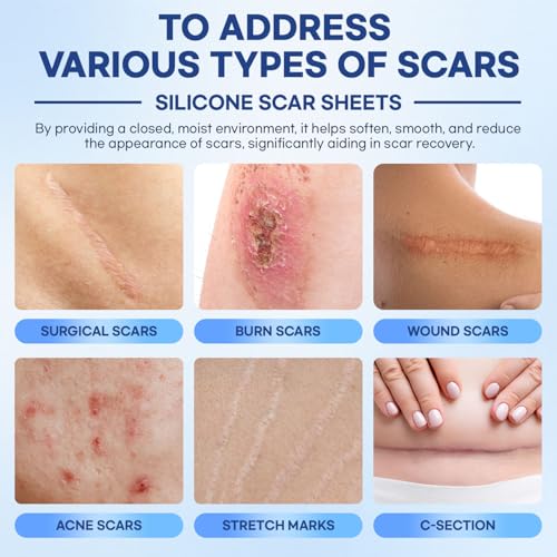Hojas de Silicona para Cicatrices Aroamas – Cinta de Silicona – 1.6x60 para Suavizar y Aplanar Cicatrices, Cesárea, Queloides, Cirugía – - imagen 5