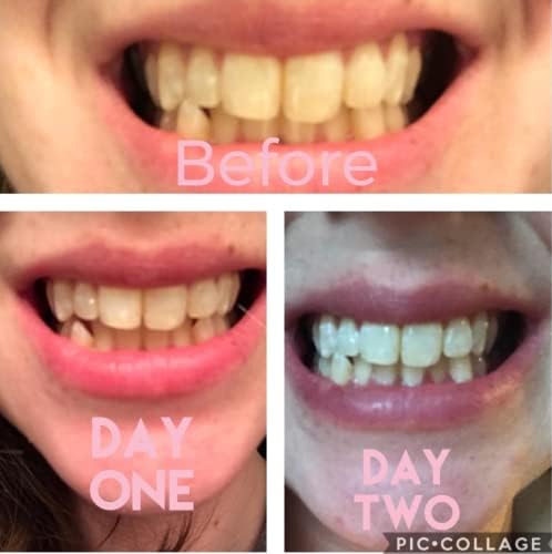 Kit de Blanqueamiento Dental Dr Song con 4 Jeringas, 35% Peróxido de Carbamida, Luz y Bandejas - imagen 2