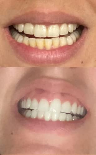 Kit de Blanqueamiento Dental Dr Song con 4 Jeringas, 35% Peróxido de Carbamida, Luz y Bandejas - imagen 3