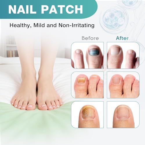 Parche Antifúngico para Uñas DR.RAPID, Tratamiento Extra Fuerte para Hongos en Uñas de Pies - 20 Parches para Tratamiento Nocturno de Hongos en Uñas - imagen 5