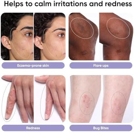 Spray Alivio Picazón QIQ – Spray de Ácido Hipocloroso de Alta Pureza, Alivio Rápido de Picaduras, Erupciones, Rasguños y Quemaduras, Sin Esteroides - imagen 3