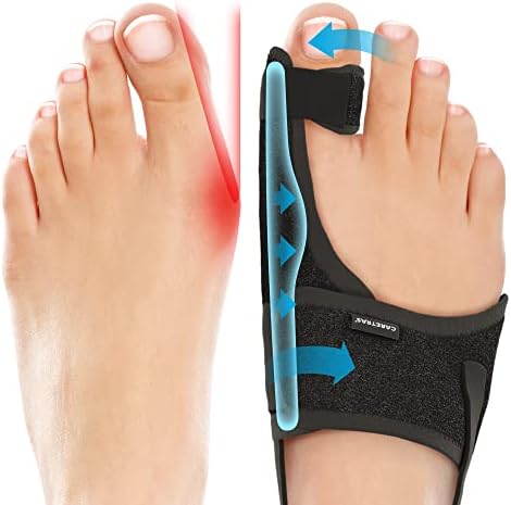 Caretras 2 Piezas Corrector de Juanetes para Mujeres y Hombres, Férula Ortopédica para Alivio del Dolor de Hallux Valgus, Separador de Dedos, Soporte - imagen 1