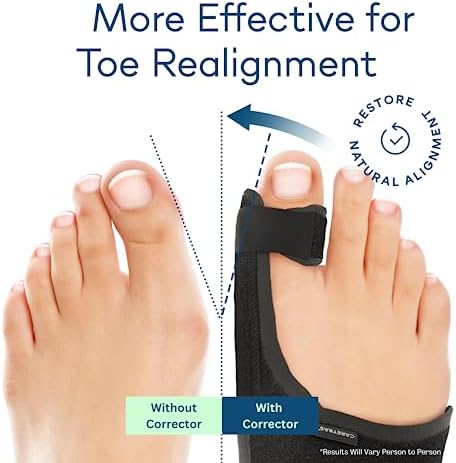 Caretras 2 Piezas Corrector de Juanetes para Mujeres y Hombres, Férula Ortopédica para Alivio del Dolor de Hallux Valgus, Separador de Dedos, Soporte - imagen 2
