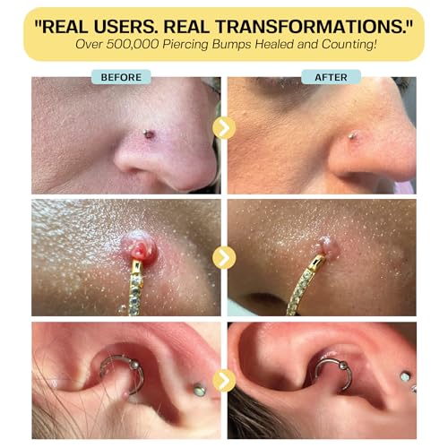 BASE LABORATORIES Dúo Reductor de Bultos por Piercing | Tratamiento para Bultos (.5oz) + Gel para Remoción de Keloides (2oz) | Eliminación de - imagen 4