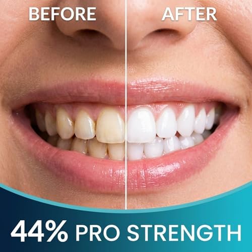 Gel Blanqueador Dental para Moldes – Fuerza Pro 44% Peróxido de Carbamida, 5 Jeringas (50 Usos) + 2 Moldes, Blanqueador Seguro para Esmalte, Elimina - imagen 8