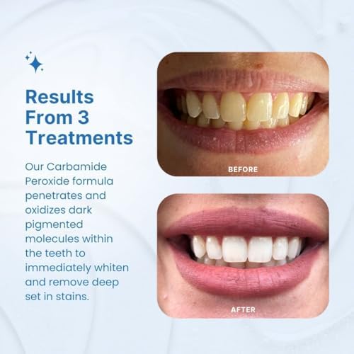 Kit de Blanqueamiento Dental PurelyWHITE DELUXE, Completo con LED, 15+ Tratamientos, (3) Jeringas de Gel Blanqueador de 3ml, Sonrisa Más Blanca en 7 - imagen 3