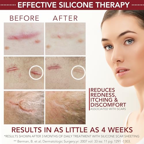 Gel y Crema de Silicona HealFast para Cicatrices Quirúrgicas - Tratamiento Médico para Keloides, Acné, Quemaduras, Cesáreas y Estrías - Fórmula - imagen 4