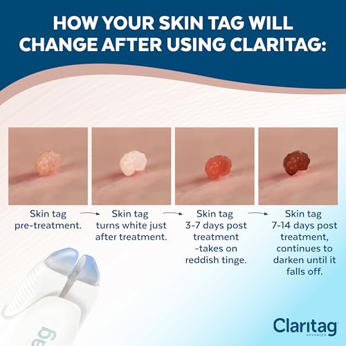 Claritag Removedor Avanzado de Etiquetas de Piel - Dispositivo Aprobado por la FDA - Solo para Remoción de Etiquetas - Resultados en 7-14 Días - - imagen 4