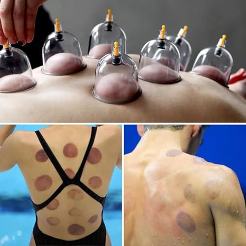 Kit de Ventosas Cupluw para Terapia de Masaje - Set Profesional de 32 Copas Chinas con Magnetismo, Terapia de Ventosas para Reducción de Celulitis y - imagen 8
