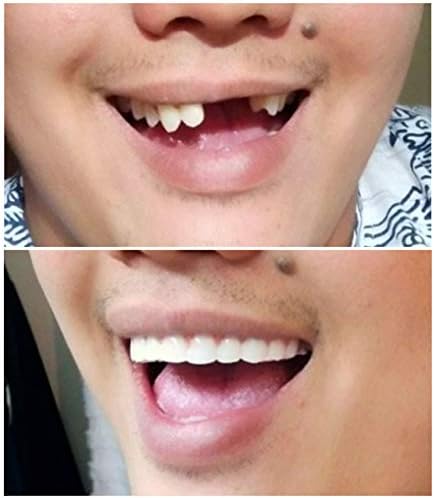 Instant Smile Comfort Fit Flex - Dientes Cosméticos de Resina Superior en Tono Brillante - imagen 5