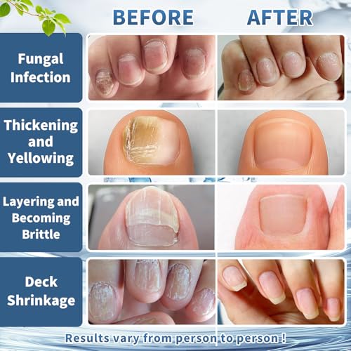 BeamBalm Tratamiento Máxima Potencia para Hongos en Uñas - Gotas Líquidas de Acción Rápida para Uñas de Manos y Pies, Restaura y Repara Uñas Dañadas - imagen 6