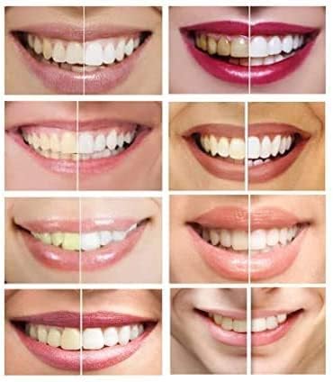 Gel blanqueador de dientes White Teeth Global 10 jeringas (3ml) 44% peróxido de carbamida, el más fuerte (no incluye bandejas bucales) - imagen 4