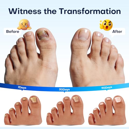 Bolígrafo para Hongos en Uñas Villsure - Tratamiento Extra Fuerte para Hongos, 25% Ácido Undecenoico, Aceite de Árbol de Té y Ingredientes Naturales, - imagen 4