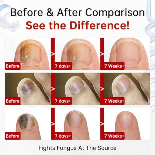 Tratamiento para Hongos en Uñas de Pies Extra Fuerte, 1% Tolnaftato, Antifúngico para Uñas Dañadas, 0.51 fl oz (Paquete de 1) - imagen 3