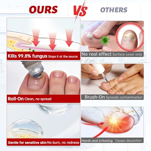 Tratamiento para Hongos en Uñas de Pies Extra Fuerte, 1% Tolnaftato, Antifúngico para Uñas Dañadas, 0.51 fl oz (Paquete de 1) - imagen 5