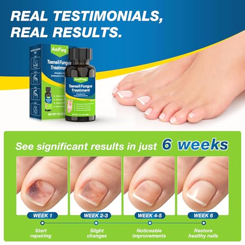 Tratamiento para Hongos en Uñas Extra Fuerte – Máxima Fórmula OTC con 25% Ácido Undecilénico – Fortalecedor y Crecimiento para Uñas Gruesas, Rojas y - imagen 2