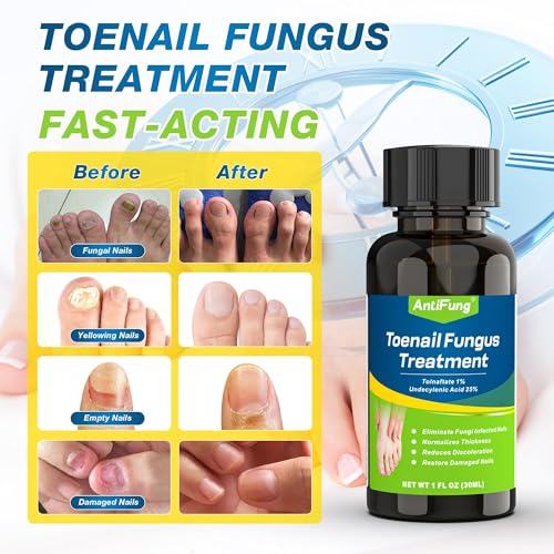 Tratamiento para Hongos en Uñas Extra Fuerte – Máxima Fórmula OTC con 25% Ácido Undecilénico – Fortalecedor y Crecimiento para Uñas Gruesas, Rojas y - imagen 4