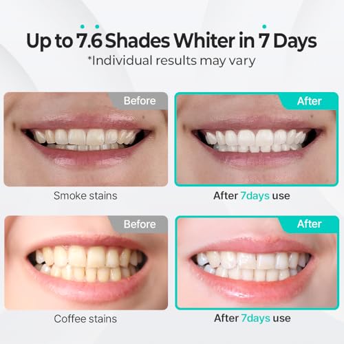 Kit de Blanqueamiento Dental Live Orals PureDia - Set de Gel y Boquilla, Peróxido de Hidrógeno, Formulado por Dentistas para Dientes Sensibles, 28 - imagen 4