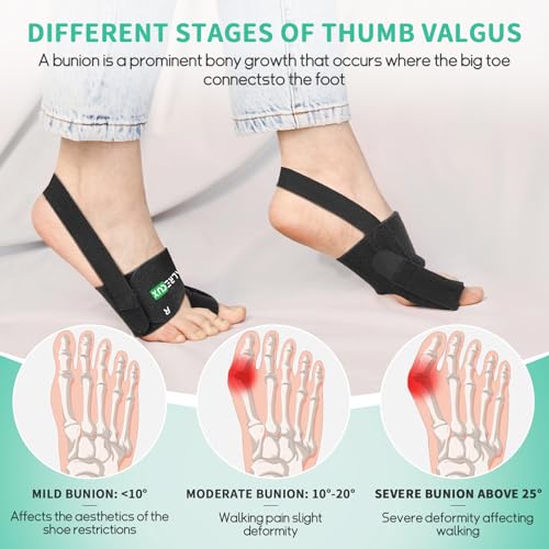 Corrector de Juanetes Healrecux para Mujeres y Hombres, Férula para Hallux Valgus, Enderezador de Dedo Gordo para Uso Diario, 1 Par - imagen 4