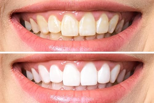 Gel Blanqueador Dental Dr. George con Instrucciones - imagen 6