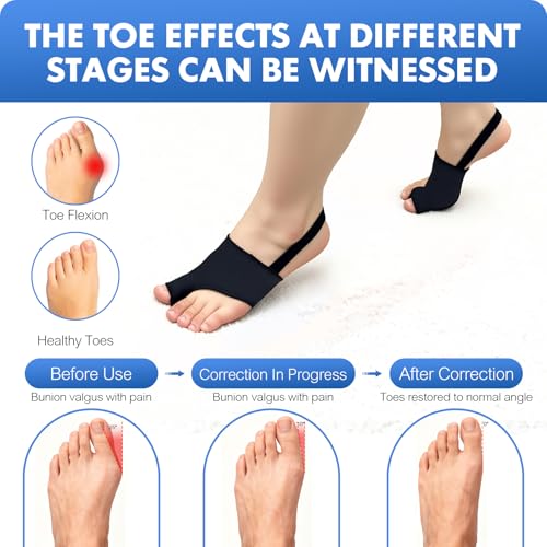 Corrector de Juanetes QCCL 2 Piezas para Mujeres y Hombres con Splint y Almohadillas para Alivio del Dolor de Hallux Valgus y Enderezador de Dedo - imagen 5