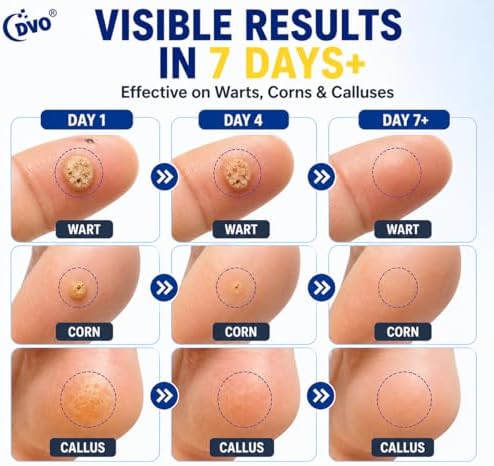 DVO Líquido Removedor de Verrugas con 20% de Ácido Salicílico, Máxima Potencia, Rápido y Sin Dolor, 30ML, para Hombres y Mujeres - imagen 4