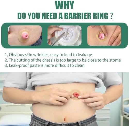 30 Piezas de Anillos de Barrera Ostomía de 4mm, Cinta Hidrocoloide Elástica, Sellos Cohesivos, Extensores de Piel para Bolsas de Colostomía, - imagen 3