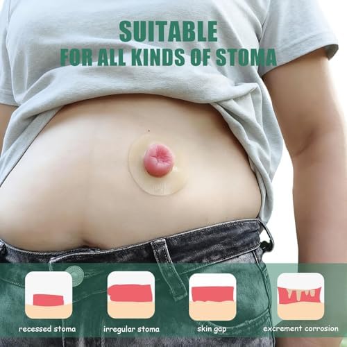 30 Piezas de Anillos de Barrera Ostomía de 4mm, Cinta Hidrocoloide Elástica, Sellos Cohesivos, Extensores de Piel para Bolsas de Colostomía, - imagen 4