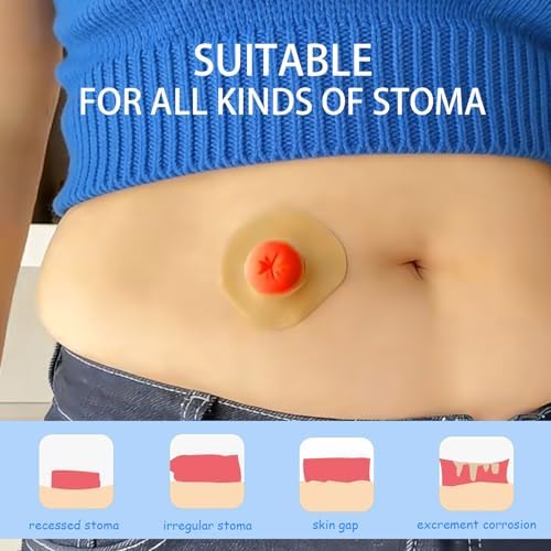Anillo Barrera Ostomía TNTNDAY 40PCS, Anillos Adaptables de 2mm para Bolsa de Ostomía, Suministros para Colostomía, Ileostomía y Urostomía, Sellos - imagen 2