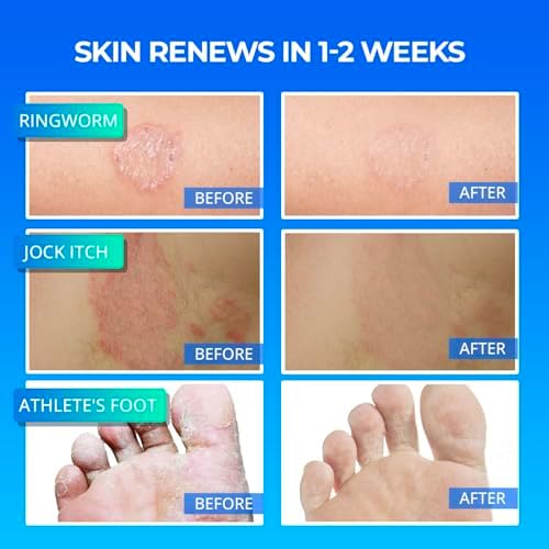 Crema Antifúngica TAGRID para Tratamiento de Tiña en Humanos: Fórmula con 1% Clotrimazol para Pies y Cuerpo Irritados - 3.38 oz - imagen 6
