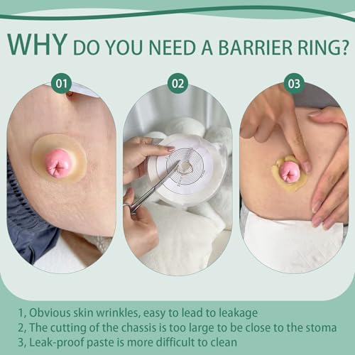 Anillos de Barrera Ostomía XIIFIIFII 30 Piezas, Cinta Hidrocoloide de 2mm, Sellos Cohesivos, Extensores de Piel Moldables para Bolsa de Colostomía, - imagen 3