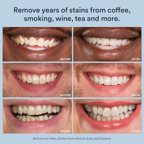 Gel Blanqueador Auraglow 44% para Trays, Retenedores y Alineadores – Blanqueador de Peróxido de Carbamida de Fuerza Dental, 30 Tratamientos, 3 - imagen 7