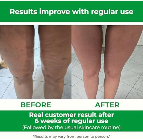 Masajeador Manual Anticelulitis TESMED: Hecho en Italia, Patente con Tecnología de Rodillos Convergentes y Divergentes para Muslos y Glúteos - imagen 4