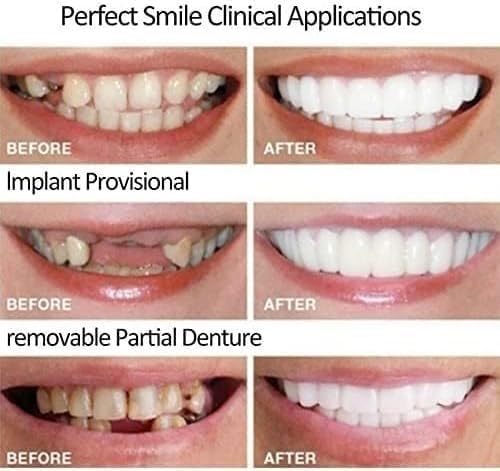 2 Paquetes de Kits de Blanqueamiento Dental para Mujeres y Hombres, Sonrisa Natural y Cómoda, Recupera tu Confianza - imagen 4